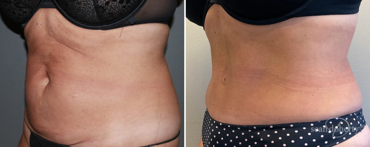 Mommy Makeover Before and After Photos in Boston, MA, Patient 14720