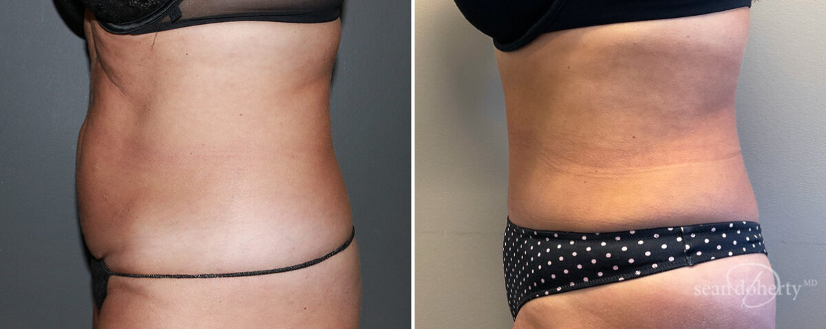 Mommy Makeover Before and After Photos in Boston, MA, Patient 14720