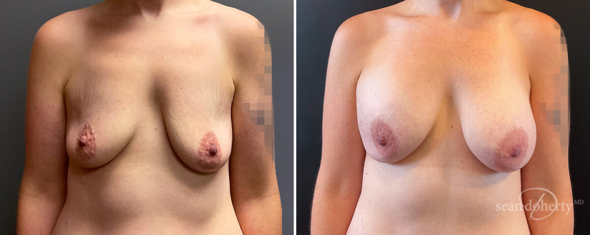 Breast Augmentation Before and After Photos in Boston, MA, Patient 14730