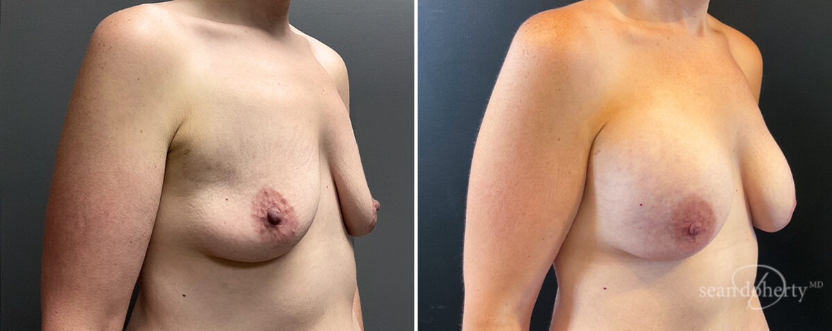 Mommy Makeover Before and After Photos in Boston, MA, Patient 14760