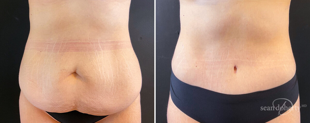 Mommy Makeover Before and After Photos in Boston, MA, Patient 14760