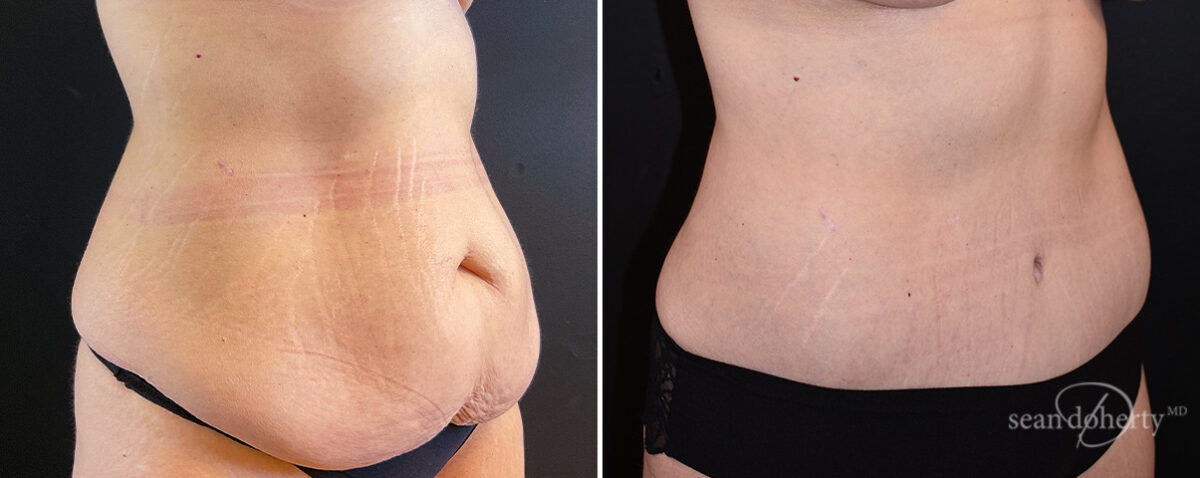 Mommy Makeover Before and After Photos in Boston, MA, Patient 14760