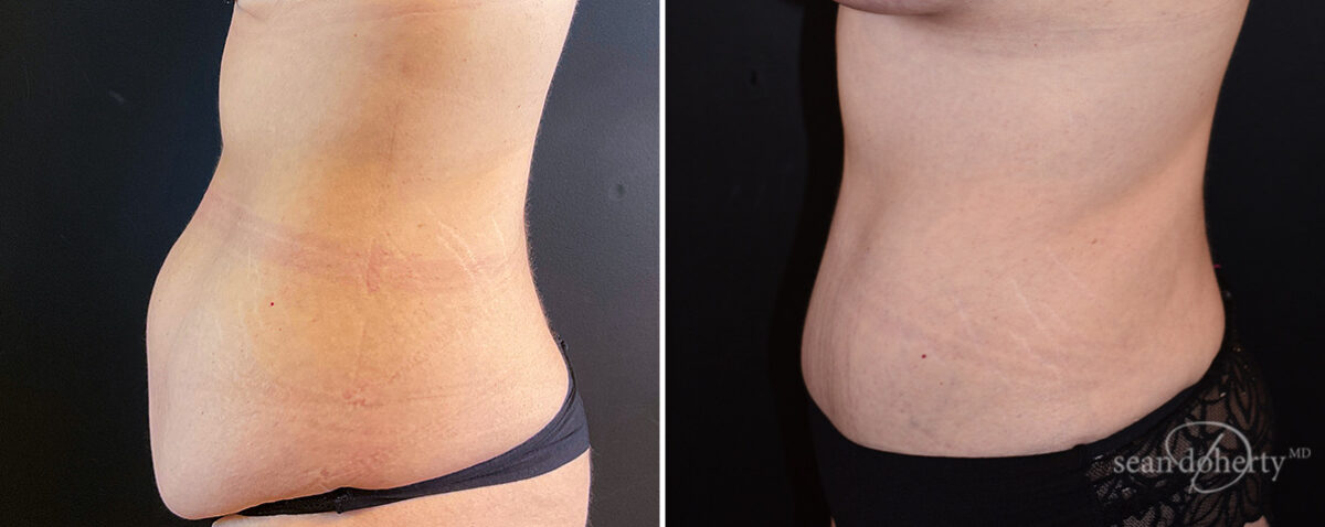 Mommy Makeover Before and After Photos in Boston, MA, Patient 14760