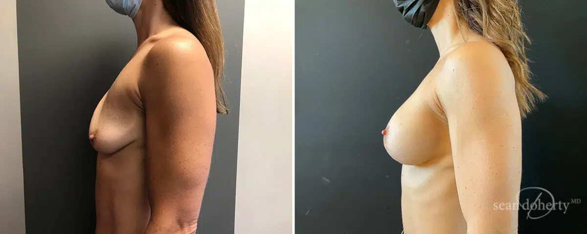 Breast Implant Exchange Before and After Photos in Boston, MA, Patient 15641