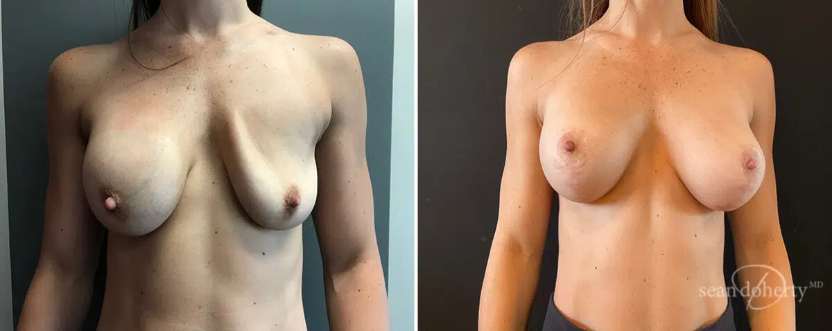 Breast Implant Exchange Before and After Photos in Boston, MA, Patient 15641