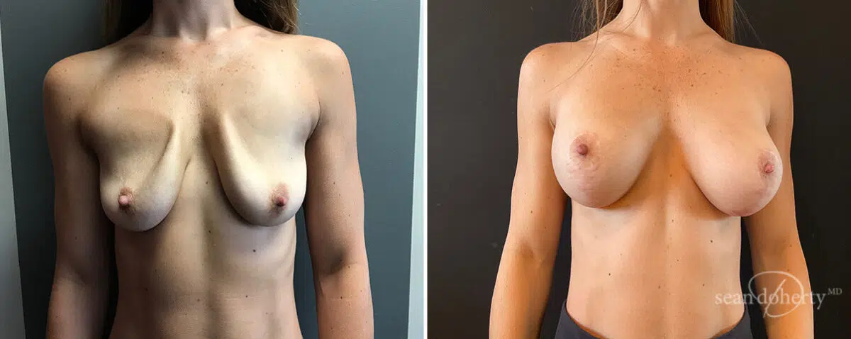Breast Implant Exchange Before and After Photos in Boston, MA, Patient 15641