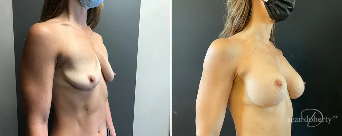 Breast Implant Exchange Before and After Photos in Boston, MA, Patient 15641