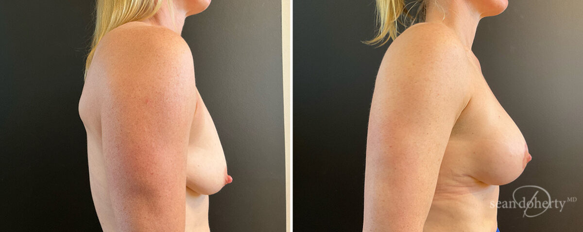 Breast Lift with Implants Before and After Photos in Boston, MA, Patient 15689