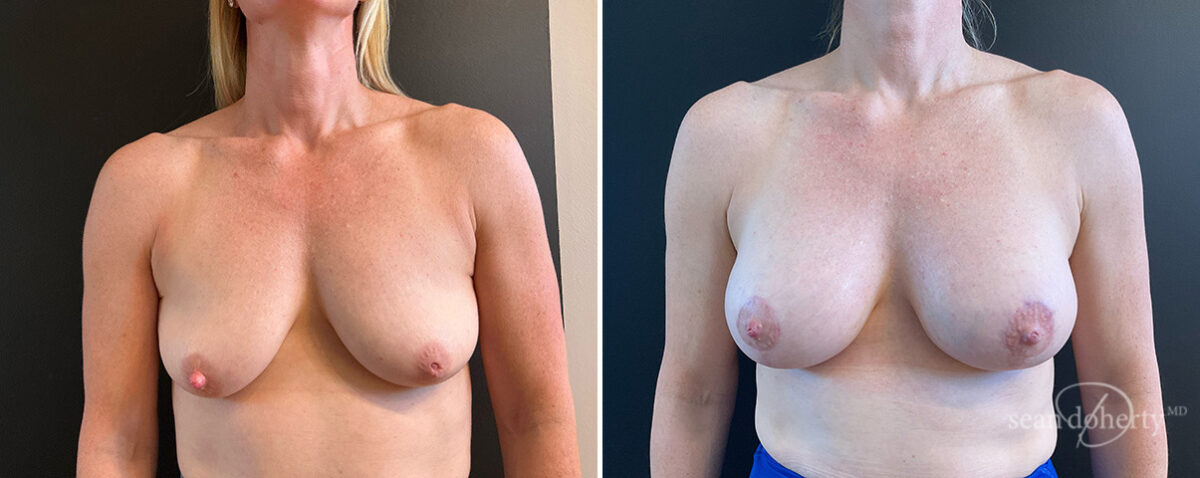 Breast Lift with Implants Before and After Photos in Boston, MA, Patient 15689