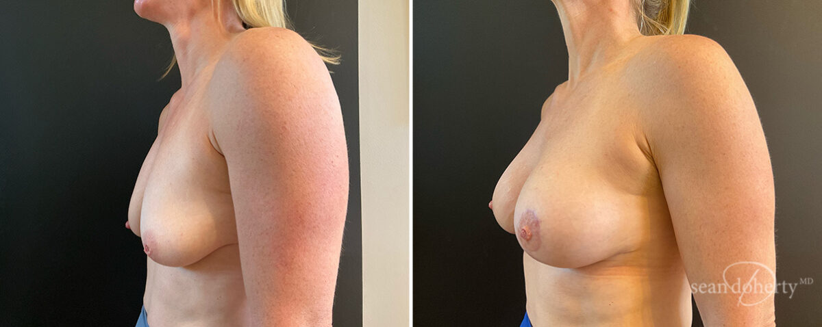 Breast Lift with Implants Before and After Photos in Boston, MA, Patient 15689