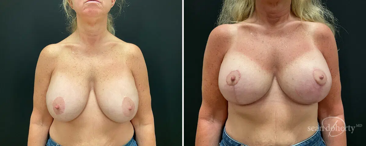 Breast Implant Exchange Before and After Photos in Boston, MA, Patient 15701
