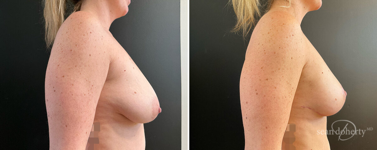 Breast Lift Before and After Photos in Boston, MA, Patient 15713