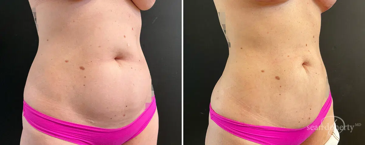 Liposuction Before and After Photos in Boston, MA, Patient 15723