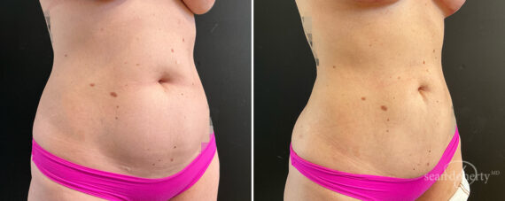 Liposuction Before and After Photos in Boston, MA, Patient 15723