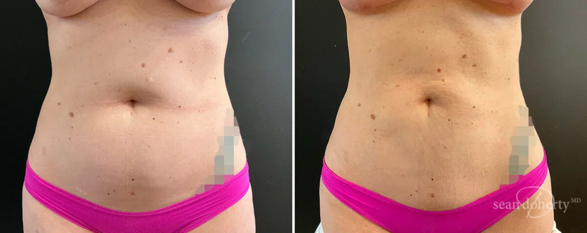 Liposuction Before and After Photos in Boston, MA, Patient 15723