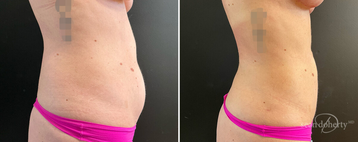 Liposuction Before and After Photos in Boston, MA, Patient 15723