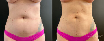 Liposuction Before and After Photos in Boston, MA, Patient 15723