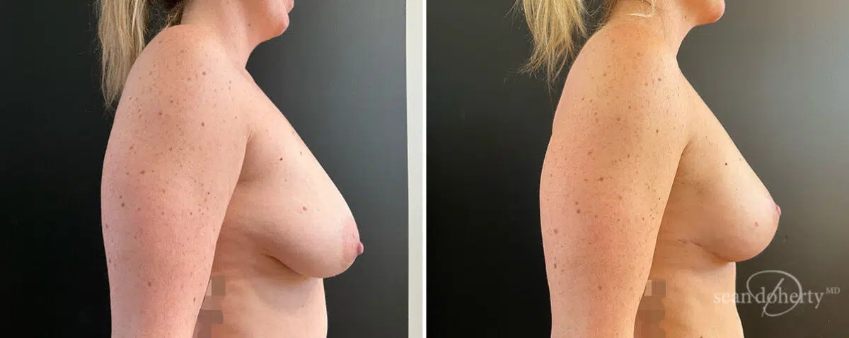 Mommy Makeover Before and After Photos in Boston, MA, Patient 15727