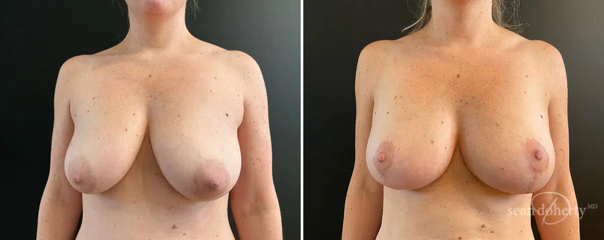 Mommy Makeover Before and After Photos in Boston, MA, Patient 15727