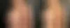 Mommy Makeover Before and After Photos in Boston, MA, Patient 15727