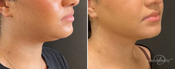 Liposuction Before and After Photos in Boston, MA, Patient 15739