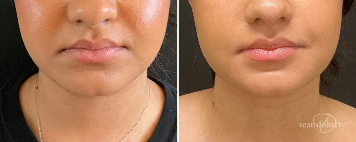Liposuction Before and After Photos in Boston, MA, Patient 15739