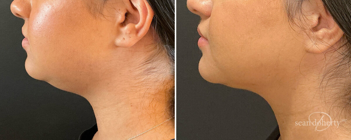 Liposuction Before and After Photos in Boston, MA, Patient 15739