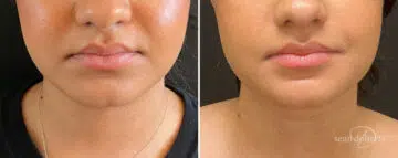 Liposuction Before and After Photos in Boston, MA, Patient 15739