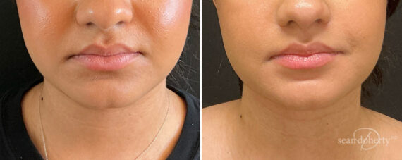 Liposuction Before and After Photos in Boston, MA, Patient 15739