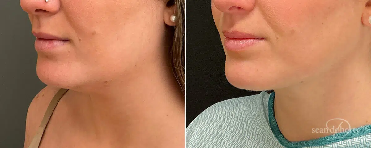 Liposuction Before and After Photos in Boston, MA, Patient 15767
