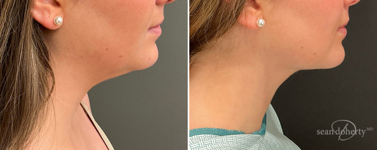 Liposuction Before and After Photos in Boston, MA, Patient 15767