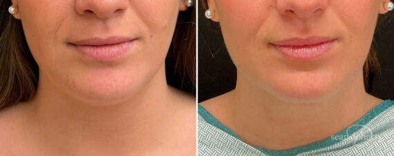 Liposuction Before and After Photos in Boston, MA, Patient 15767