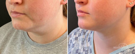 Liposuction Before and After Photos in Boston, MA, Patient 15771
