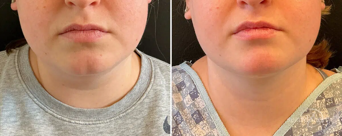Liposuction Before and After Photos in Boston, MA, Patient 15771