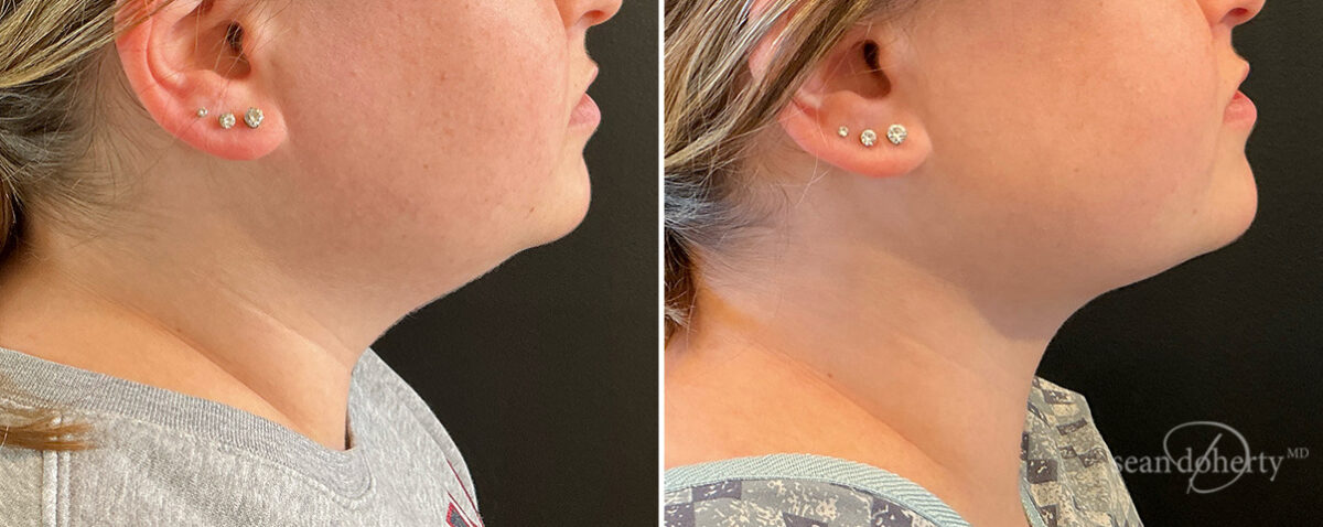 Liposuction Before and After Photos in Boston, MA, Patient 15771