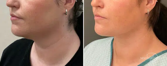 Liposuction Before and After Photos in Boston, MA, Patient 15775