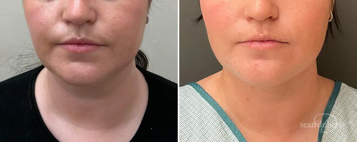 Liposuction Before and After Photos in Boston, MA, Patient 15775