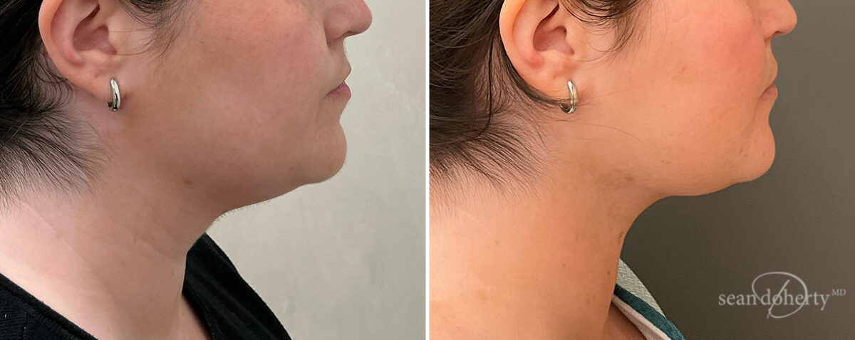 Liposuction Before and After Photos in Boston, MA, Patient 15775