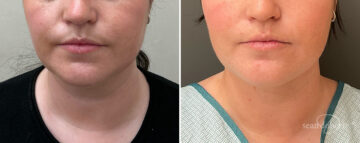 Liposuction Before and After Photos in Boston, MA, Patient 15775
