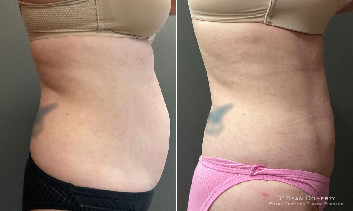 Liposuction Before and After Photos in Boston, MA, Patient 10391