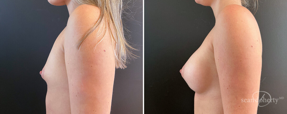 Breast Augmentation Before and After Photos in Boston, MA, Patient 16363