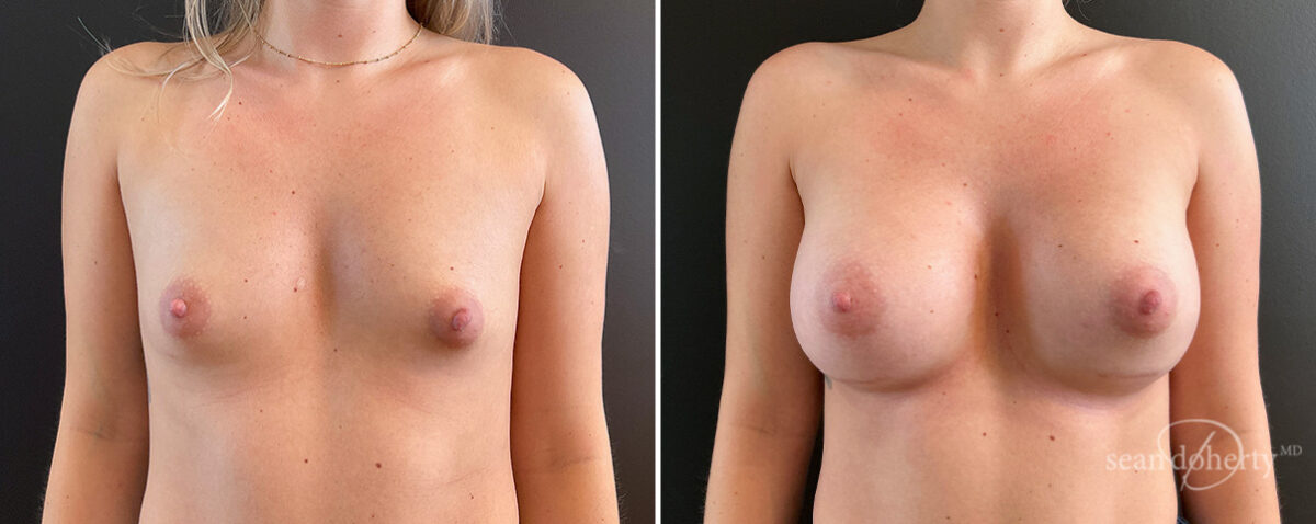 Breast Augmentation Before and After Photos in Boston, MA, Patient 16363