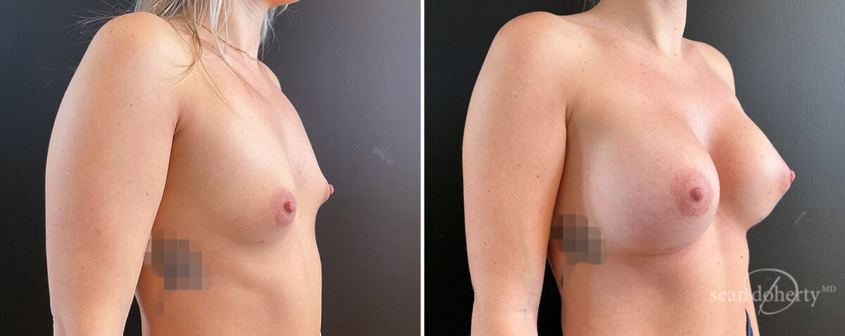 Breast Augmentation Before and After Photos in Boston, MA, Patient 16363