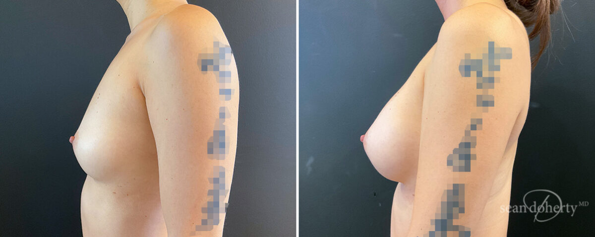 Breast Augmentation Before and After Photos in Boston, MA, Patient 16373