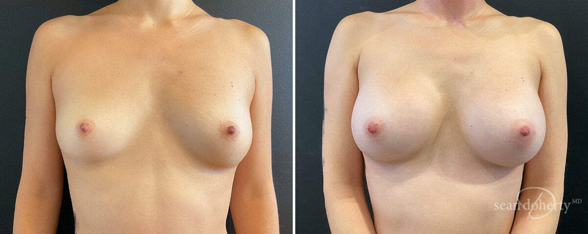 Breast Augmentation Before and After Photos in Boston, MA, Patient 16373