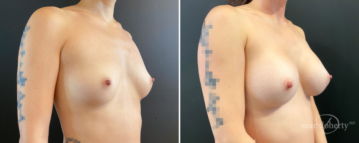 Breast Augmentation Before and After Photos in Boston, MA, Patient 16373
