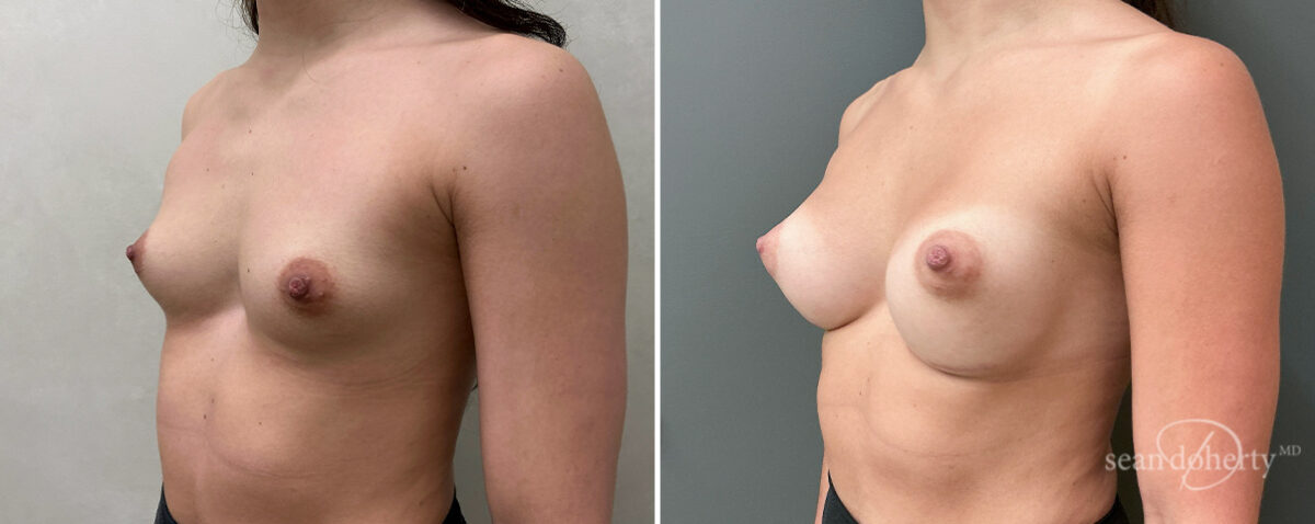 Breast Augmentation Before and After Photos in Boston, MA, Patient 16383