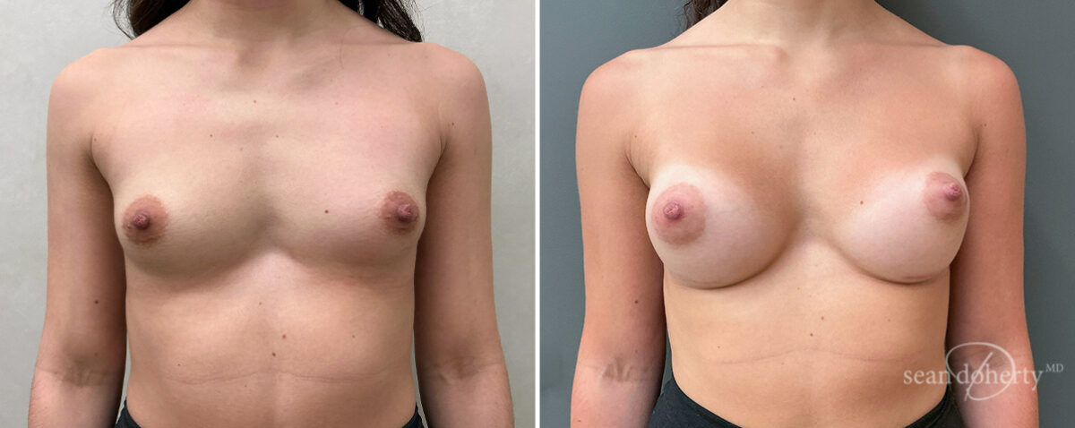 Breast Augmentation Before and After Photos in Boston, MA, Patient 16383