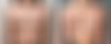 Breast Augmentation Before and After Photos in Boston, MA, Patient 16383