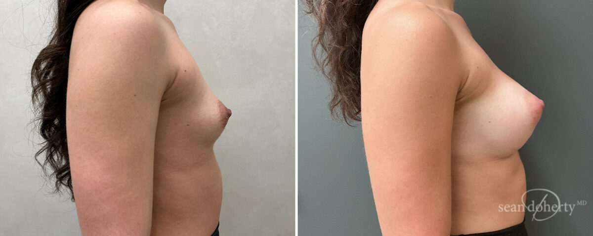 Breast Augmentation Before and After Photos in Boston, MA, Patient 16383